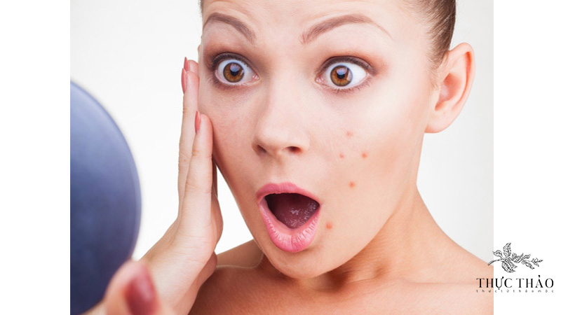Thay đổi nội tiết tố là nguyên nhân chính gây ra mụn ở phụ nữ mang thai