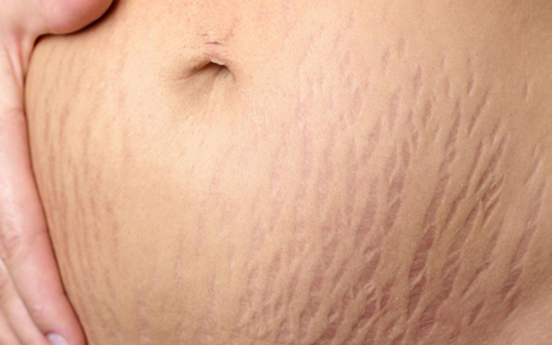 Cách trị rạn nứt da hiệu quả tại nhà